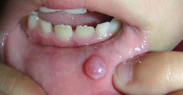 Cyst Removal
